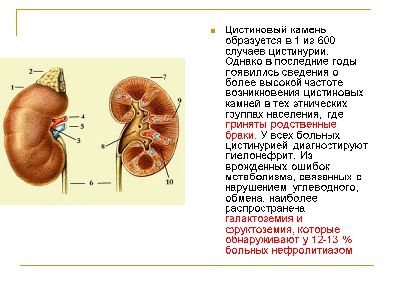 Цистиновый камень образуется в 1 из 600 случаев цистинурии. Однако в последние годы появились